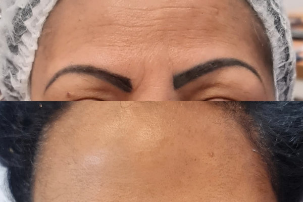 Lentes de Porcelana em Pinheiros - Belfort Odontologia